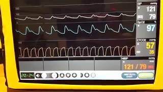 Basic Capnography [upl. by Hungarian]