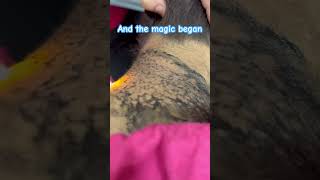 Laser treatment of hyperpigmentation skincare skintreatment viral skincaretips beautytips [upl. by Drawde]