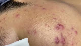 Effective Acne Scar Treatments for Smooth Skin Addressing Cystic Acne Fungal Acne and Hormonal Acn [upl. by Daniela255]