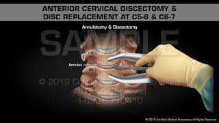 Anterior Cervical Discectomy amp Disc Replacement at C56 amp C67  Medical Animation [upl. by Alilak]