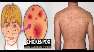 Chickenpox Causes Signs and Symptoms Diagnosis and Treatment [upl. by Stacy]