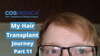 Hair Transplant Journey part 11 Ten months update  Cosmedica [upl. by Ainod795]