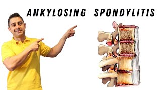 Ankylosing Spondylitis core exercises [upl. by Georgy]