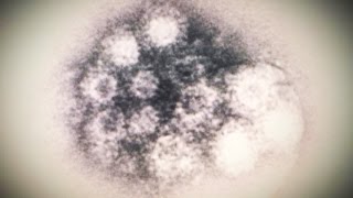 Mysterious Virus May Include Paralysis [upl. by Ivonne]