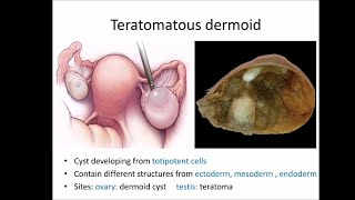 Dermoid cyst [upl. by Mckenna]