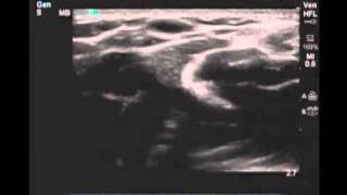 How To Peripheral Arm Veins for Vascular Access Scanning Technique Video [upl. by Burne]