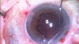 iris capture repair with pupil reconstruction by Steven G Safran MD [upl. by Lanuk565]