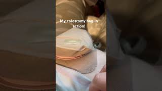 Colostomy bag in action colostomy [upl. by Ahsaret]