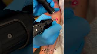 Picosure Laser Tattoo Removal Your Path to a Blank Canvas  Erasing Ink [upl. by Irtak]