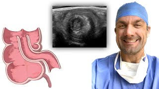 Intussusception  Making the Diagnosis [upl. by Eimar]