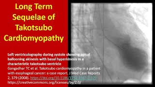 Long Term Sequelae of Takotsubo Cardiomyopathy [upl. by Sila]