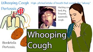 Whooping cough  Pertussis Hacking cough Symptoms and treatment [upl. by Akena270]