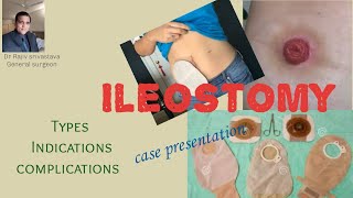 What is an ileostomy Typesindications and complications case presentation [upl. by Einnoj768]