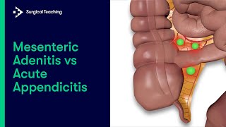 Mesenteric Adenitis vs Appendicitis  How to tell the difference [upl. by Hasin]