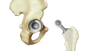 PreOp® Total Hip Replacement [upl. by Harper]