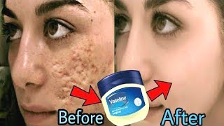 In 3 Days  Remove DARK SPOTS BLACK SPOTS amp ACNE SCARS  Vaseline Hacks  Home Remedies [upl. by Airbas]