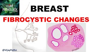 Diseases of Breast Part 1 Normal anatomy Classification amp FIBROCYSTIC CHANGES [upl. by Mikal545]