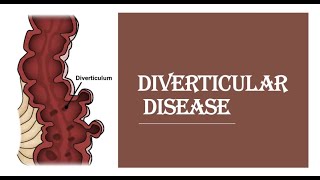 Diverticular diseasediverticulitis  pathogenesis clinical feature investigation management [upl. by Staley]