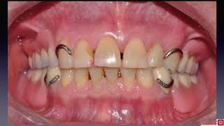 강OOClasp RPD Mxtooth modification Mnsurveyed crown [upl. by Ytsirt]