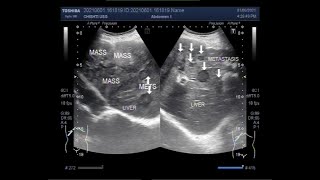 Hepatic Masses with Metastases [upl. by Dicky]