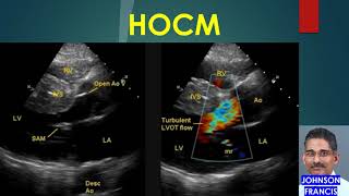 HOCM  Hypertrophic Obstructive Cardiomyopathy [upl. by Arteid85]