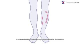 la thrombose veineuse superficielle [upl. by Skinner]