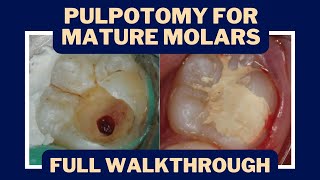 Pulpotomies for Irreversible Pulpitis The Rise of Vital Pulp Therapy  PDP133 [upl. by Heywood]