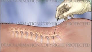 Lumbar IDET Intradiscal Electrothermal Therapy Procedure [upl. by Siuqaj]