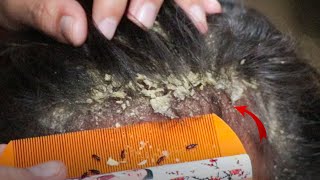 Removed Hundred of Lice From Head and Dry Scalp Huge Dandruff of Flakes Removal With Comb  1765 [upl. by Leahcir]