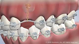 Assisted Eruption of Impacted Teeth at Warren Orthodontics Springville UT [upl. by Anaed656]