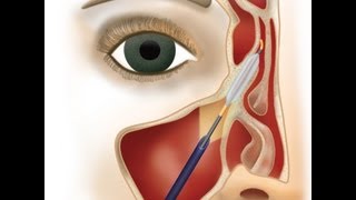 FinESS Balloon Sinus Dilation in the office under local anesthesia  Richmond ENT [upl. by Melisande]