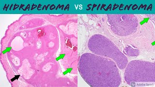 Hidradenoma Acrospiroma vs SpiradenomaCylindroma 5Minute Pathology Pearls [upl. by Lambard]