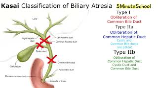 Kasai Classification of BIliary Atresia [upl. by Ahsiakal]