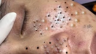 Big Cystic Acne Blackheads Extraction Blackheads amp Milia Whiteheads Removal Pimple Popping  337 [upl. by Base333]