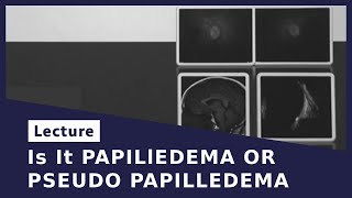 Is It PAPILlEDEMA OR PSEUDO PAPILLEDEMA [upl. by Carrelli50]