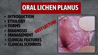 Lichen Planus  Oral Lichen Planus  Lichen Planus Best Lecture [upl. by Asilej]