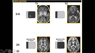 Myelination in MRI 14 simplified [upl. by Inanuah]