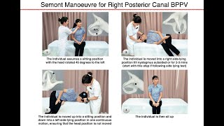 Semont Manoeuvre for Right Posterior Canal BPPV [upl. by Nairim]