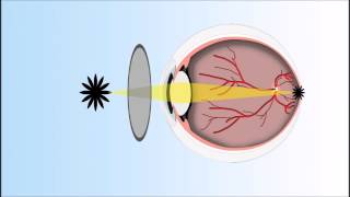 Presbyopia Explained Annimated Video [upl. by Negiam921]