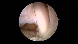 os trigonum syndrome [upl. by Fowler101]