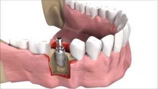 How DENTAL IMPLANTS are inserted  3D simulation [upl. by Nosidam]