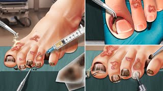 ASMR Remove ingrown toenails cut toenails and beautify toenails [upl. by Dianna]