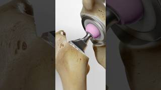 Total hip replacement explained 3D Animation [upl. by Schroer934]