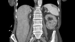 Renal cortical necrosis on CT [upl. by Aivatnahs]