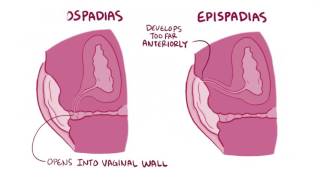 Hypospadias amp epispadias causes symptoms diagnosis treatment pathology [upl. by Gunner579]