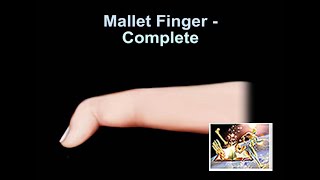 Mallet Finger Complete  Everything You Need To Know  Dr Nabil Ebraheim [upl. by Dopp]