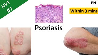 Psoriasis  A Quick Revision  Dermatology  HYT 7  NEETPG  INICET [upl. by Ocirne]