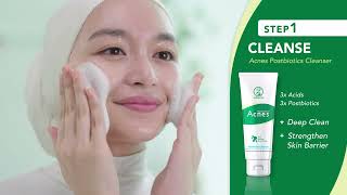 Acnes 3 Simple Steps to AcneFree Skin [upl. by Tedie]