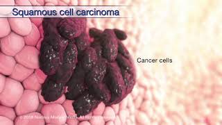 Understanding Head and Neck Cancer [upl. by Llerroj]