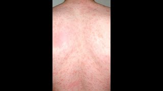 Comment Se Débarrasser Du Pityriasis Versicolore Pour De Bon [upl. by Ashman]